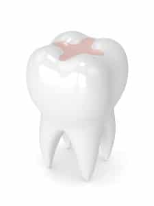 3d render of tooth with dental inlay filling isolated over white background