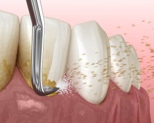 Oral hygiene: Scaling and root planing (conventional periodontal therapy). Medically accurate 3D illustration of human teeth treatment