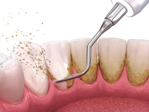 Oral hygiene: Scaling and root planing (conventional periodontal therapy). Medically accurate 3D illustration of human teeth treatment