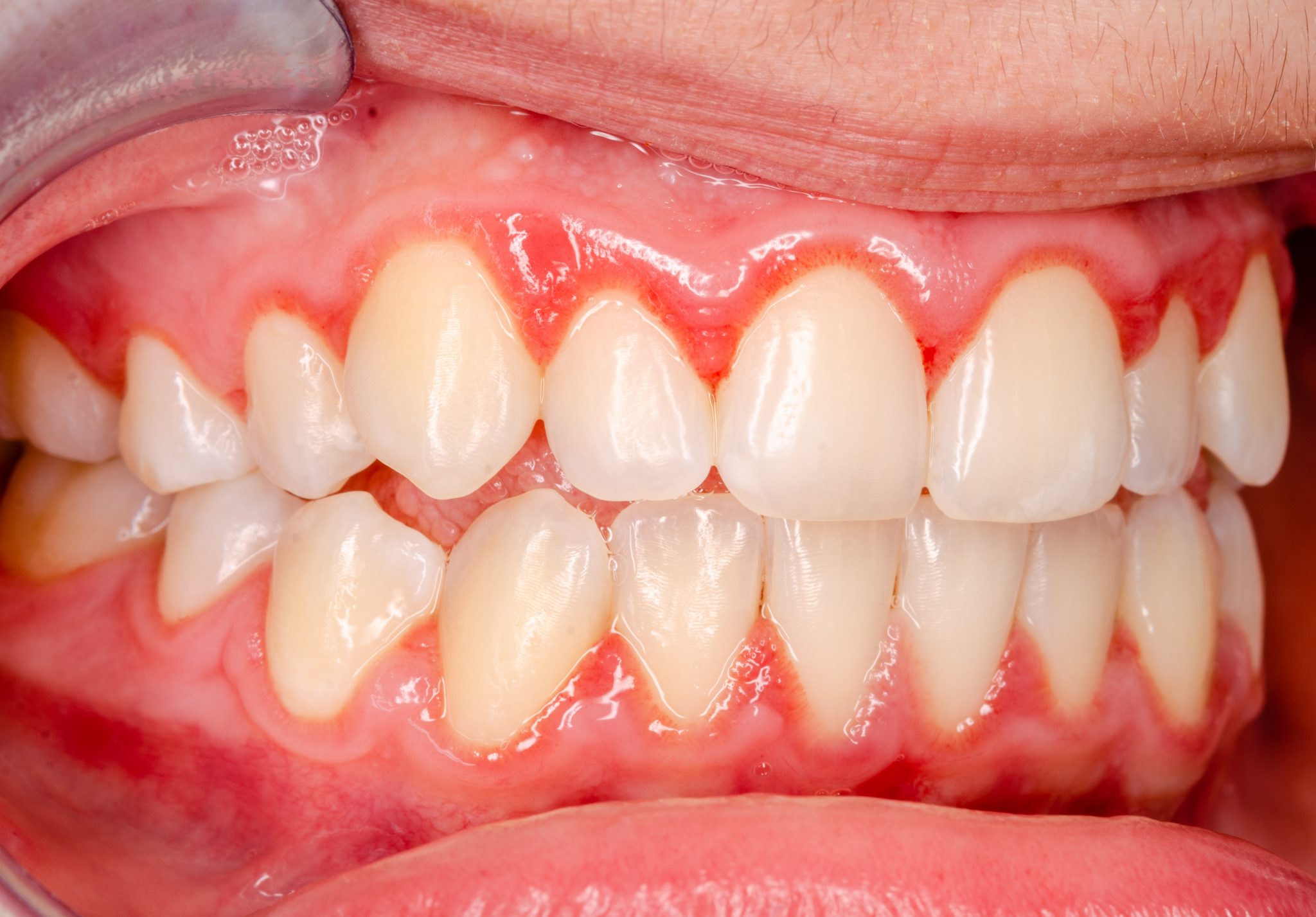 Treating Severe Gingivitis With Minor Perio Surgery | Dallas, TX