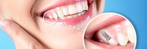 Dallas, TX, dentist offers dental implants