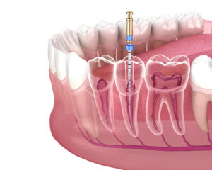 dallas root canal