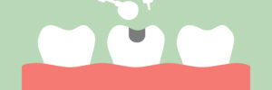 teeth cartoon vector flat style for design - tooth amalgam filling with dental tools