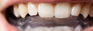 dallas bruxism