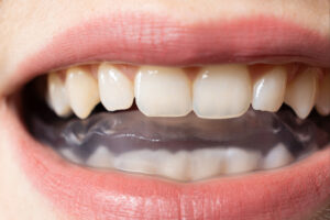 dallas bruxism
